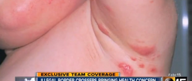 Scabies from ABC15