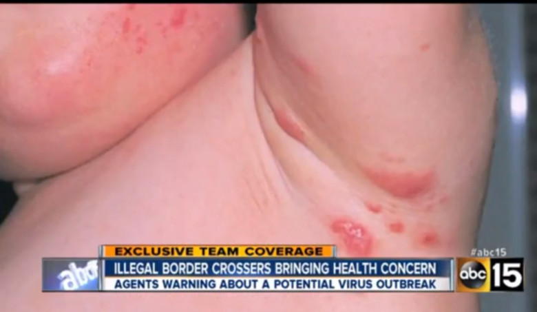 Scabies from ABC15